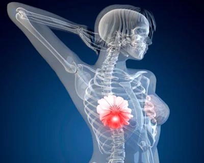 Breast Cancer: 5 Tips to Prevent the Risk