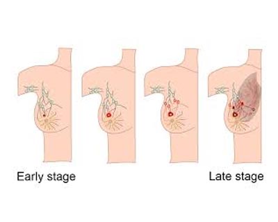 The Goals of Different Breast Cancer Operations