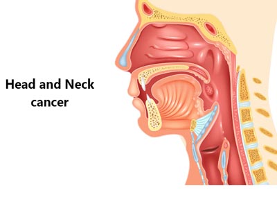 head-neck-tumor