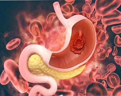 stomach-cancer