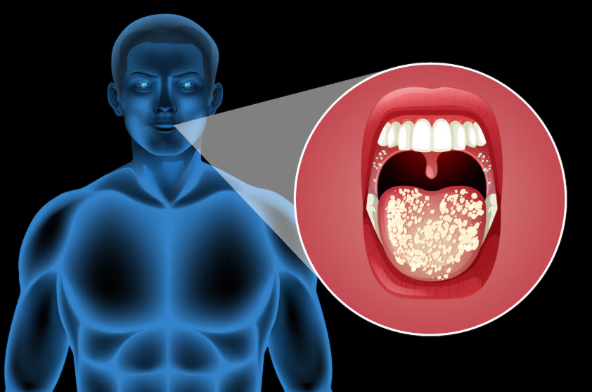 Oral Cancer: Causes, Symptoms, Early Detection & Prevention